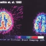 Brain scan to illustrate how memory techniques can light up the right side of the brain