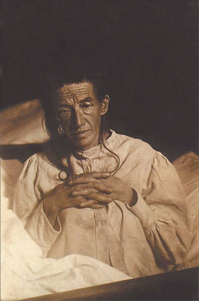 Image of Auguste Dieter Alzheimer's Patient