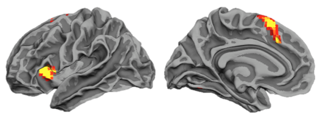 Brain scan of weak memory to illustrate how memory improvement and the Magnetic Memory Method Masterclass fails learners